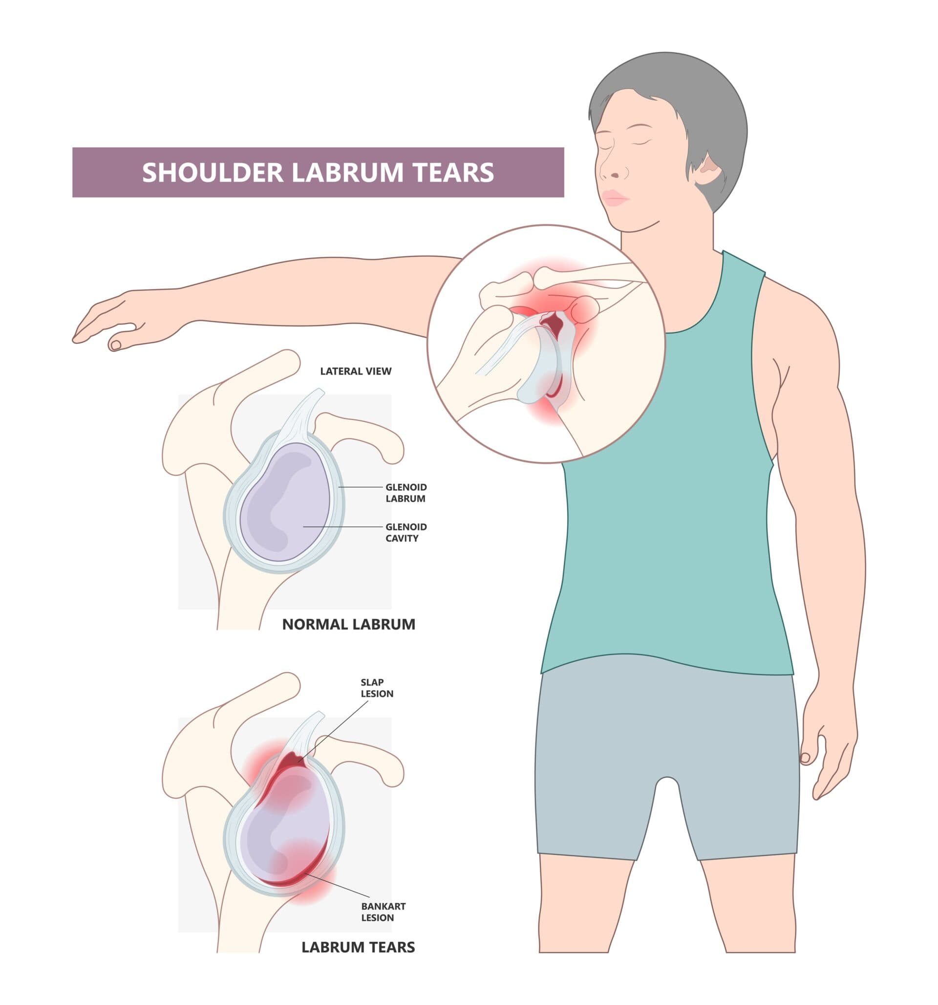 Anatomical illustration of shoulder instability and labral tear