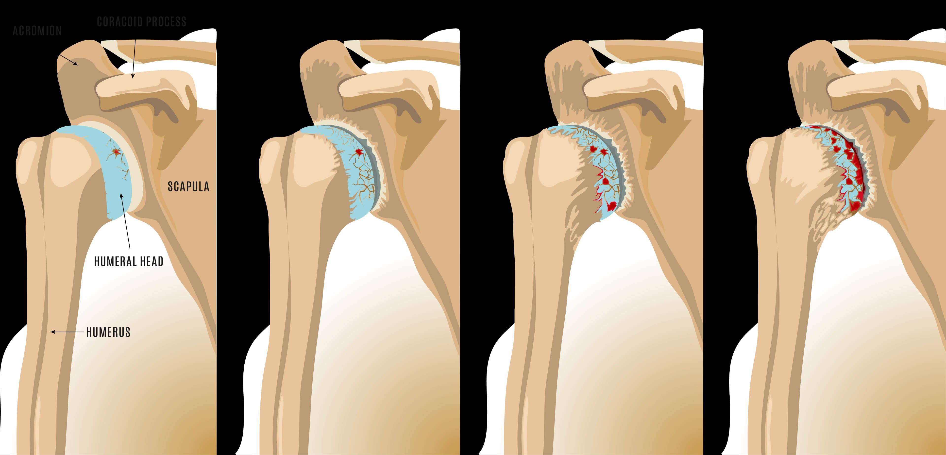 Anatomical illustration of shoulder arthritis